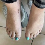 Leigh's feet after a pedicure following her first round of scrambler therapy in 2022.