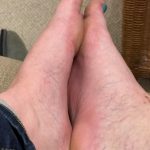 Leigh's foot after her first round of scrambler therapy, with less swelling and more normal colour.