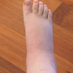 Leigh's swollen foot and ankle after her second surgery in 2020.