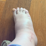 Leigh's swollen, discoloured ankle in 2021.