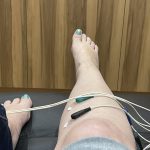 Leigh's ankle with scrambler therapy electrodes attached in 2022.