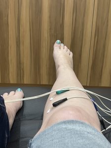 Leigh's foot and ankle with scrambler therapy electrodes attached during a 2022 session.